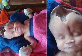 Image result for Oldest Living Baby with Anencephaly