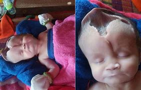 Image result for Oldest Anencephaly Baby