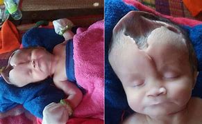 Image result for Anencephaly Newly Born Baby's
