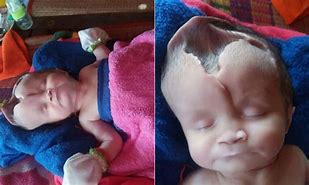 Image result for Infant Anencephaly