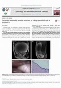 Image result for Confirmatory for Paratubal Cyst