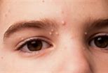 Image result for Molluscum On Eyelid