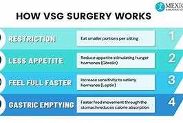 Image result for VSG Procedure
