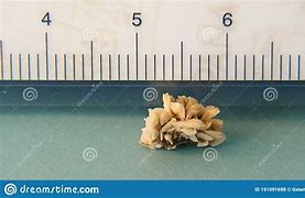 Image result for 9Mm Size Kidney Stones