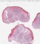 Image result for Kaposi Sarcoma