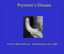 Image result for S Peryonie Disease