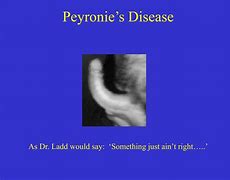 Image result for What Does Peronies Condition Look Like