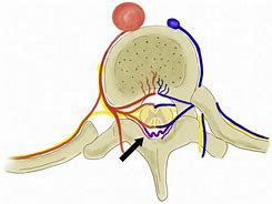 Image result for Spinal Dural AV Fistula