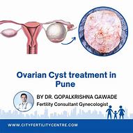 Image result for Ovarian Cysts Removed