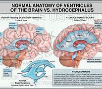 Image result for Hydrocephalus Ventricles