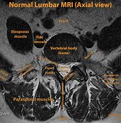 Image result for Axial T2 MRI Lumbar Spine