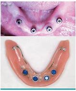 Image result for Locator Abutments
