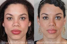 Image result for Rhinoplasty Before and After Photos