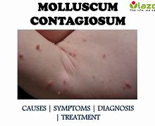 Image result for Molluscum Contagiosum Treatment Podofilox