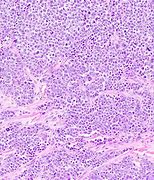 Image result for Neuroendocrine Tumor