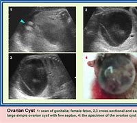 Image result for 5 Cm Ovarian Cyst