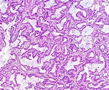 Image result for Lung Cancer Pathology
