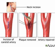 Image result for Carotid Artery Surgery