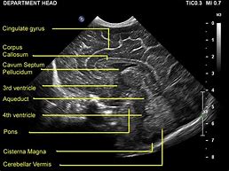 Image result for Normal Cranial Ultrasound