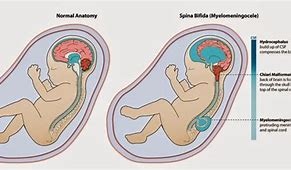 Image result for Neural Tube Defects Types