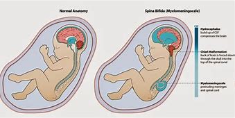Image result for Neural Tube Defects