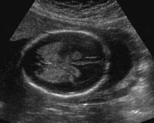 Image result for Ultrasound Images of Semilobar Holoprosencephaly