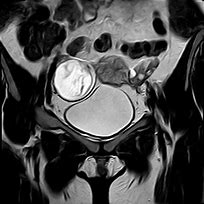 Image result for Cystadenomas Ovarian Cyst