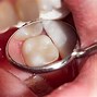 Image result for Tooth Buckle Filling