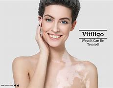 Image result for Vitiligo On White Skin