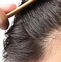 Image result for Alopecia Areata Ophiasis