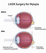 Image result for Myopia Laser Surgery
