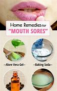 Image result for Home Remedies Mouth Sores