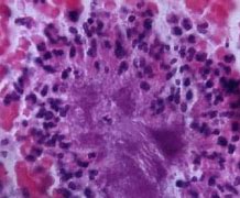 Image result for zctinomicosis