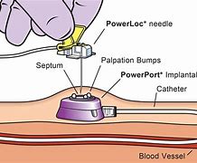 Image result for IV Catheter Bard Access Systems