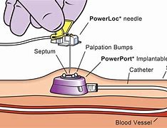 Image result for Port-a-Cath