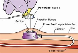 Image result for Port a Catheter