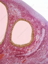 Image result for 5Cm Ovarian Cyst