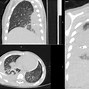 Image result for Chlamydia Pneumoniae CXR