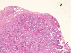 Image result for Adenocarcinoma Cervical Cancer