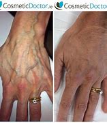 Image result for Hand Rejuvenation