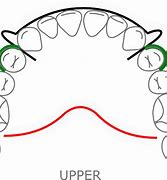 Image result for C Clasp Retainer for Denture