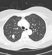 Image result for Carcinoid Lesion