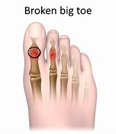 Image result for Broken Big Toe
