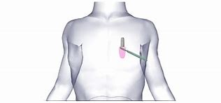 Image result for Cardiac Loop Recorder Implant