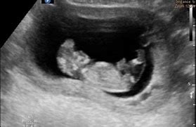 Image result for Anencephaly Fetal Brain Ultrasound