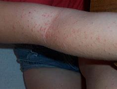 Image result for Fifth Disease in Adults
