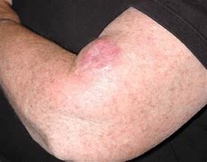 Image result for Skin Nodules On Arms