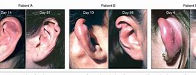 Image result for infected cartilage