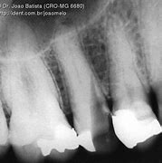 Image result for calcificae