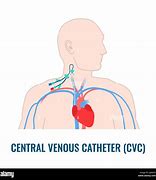 Image result for Anterior Central Venous Catheter